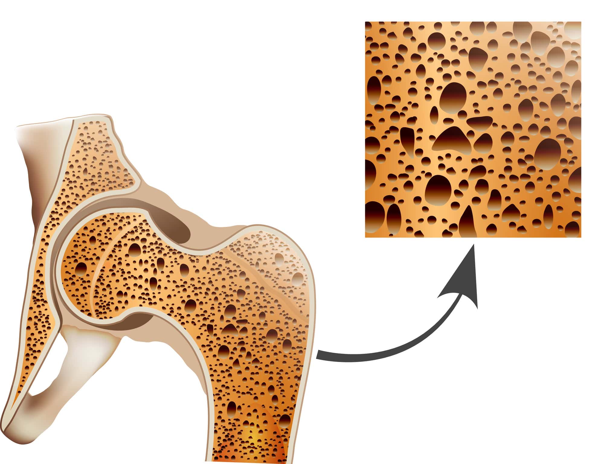 Osteoporosis in femur bone